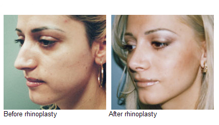 Rhinoplasty (Nose Surgery)