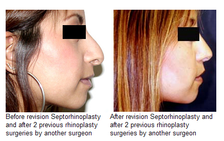 Revision Rhinoplasty