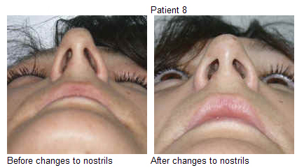 Rhinoplasty - Nostril Reshaping