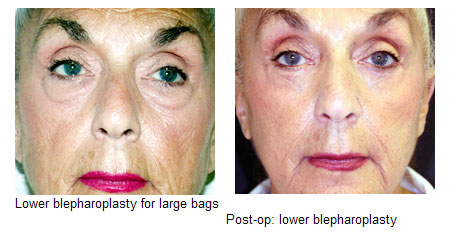 Blepharoplasty (Cosmetic Eyelid Surgery)
