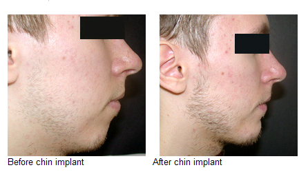 Chin Implants