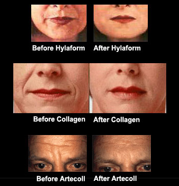 Cosmetic Injectables (Collagen, Botox, etc.)